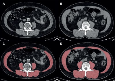 Automated segmentation of skeletal muscles at the level of the third lumbar vertebra in two representative patients with similar body mass index (BMI; calculated as weight in kilograms divided by height in meters squared) and different skeletal muscle statuses. (A, C) Axial noncontrast CT image (A) and red overlay image (C) at PET/CT in a 68-year-old male patient with a BMI of 28.1 show low skeletal muscle mass and myosteatosis, characterized by a skeletal muscle index of 44.2 cm2/m2 and a skeletal muscle radiodensity of 26.8 Houndsfield units (HU). (B, D) Axial noncontrast CT image (B) and red overlay image (D) at PET/CT in a 69-year-old male patient with a BMI of 28.4 show normal skeletal muscle mass and radiodensity, as indicated by a skeletal muscle index of 62.4 cm2M/sup>/m2 and a skeletal muscle radiodensity of 41.6 HU. Images and caption courtesy of the RSNA.
