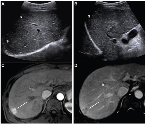 (A,B) Images from an initial ultrasound examination showed no identifiable lesions and received a consensus ultrasound category of US-1. Nearly the entire liver is visualized, with minimal shadowing (&ldquo;s&rdquo;, A and B), and the examination received consensus result of VIS-A. The AFP level was 7.1 ng/mL on assessment six months before the ultrasound, 9.1 ng/mL on assessment three months before examination, and 14.2 ng/mL on assessment on exam day. The AFP result was thus assessed as positive based on a progressive increase on two consecutive tests. The atient was considered to have negative surveillance result according to LI-RADS Ultrasound Surveillance v2017, but positive surveillance result according to LI-RADS Ultrasound Surveillance v2024. (C-D) Axial arterial-phase (C) and portal-venous phase (D) T1-weighted images from subsequent gadoxetic acid-enhanced MRI show a 2-cm arterial-phase hyperenhancing observation (arrow, C) with portal-venous washout (arrow, D) in segment 7. This observation was classified on MRI as LR-5, thus meeting the present study&rsquo;s reference standard for diagnosis of HCC. The mass is located in the periphery of the liver, an anatomic area where ultrasound visualization can be challenging due to shadowing.