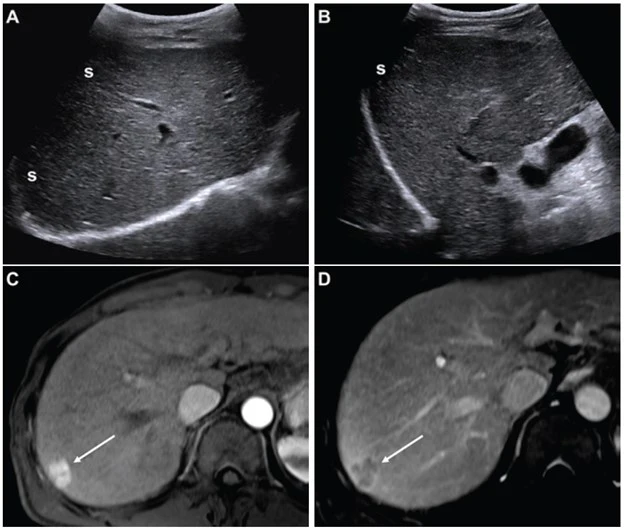 Li Rads Contrast Ultrasound LI-RADS ultrasound surveillance version 2024 improves HCC detection ...