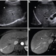 (A,B) Images from an initial ultrasound examination showed no identifiable lesions and received a consensus ultrasound category of US-1. Nearly the entire liver is visualized, with minimal shadowing (“s”, A and B), and the examination received consensus result of VIS-A. The AFP level was 7.1 ng/mL on assessment six months before the ultrasound, 9.1 ng/mL on assessment three months before examination, and 14.2 ng/mL on assessment on exam day. The AFP result was thus assessed as positive based on a progressive increase on two consecutive tests. The atient was considered to have negative surveillance result according to LI-RADS Ultrasound Surveillance v2017, but positive surveillance result according to LI-RADS Ultrasound Surveillance v2024. (C-D) Axial arterial-phase (C) and portal-venous phase (D) T1-weighted images from subsequent gadoxetic acid-enhanced MRI show a 2-cm arterial-phase hyperenhancing observation (arrow, C) with portal-venous washout (arrow, D) in segment 7. This observation was classified on MRI as LR-5, thus meeting the present study’s reference standard for diagnosis of HCC. The mass is located in the periphery of the liver, an anatomic area where ultrasound visualization can be challenging due to shadowing.