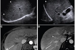 (A,B) Images from an initial ultrasound examination showed no identifiable lesions and received a consensus ultrasound category of US-1. Nearly the entire liver is visualized, with minimal shadowing (“s”, A and B), and the examination received consensus result of VIS-A. The AFP level was 7.1 ng/mL on assessment six months before the ultrasound, 9.1 ng/mL on assessment three months before examination, and 14.2 ng/mL on assessment on exam day. The AFP result was thus assessed as positive based on a progressive increase on two consecutive tests. The atient was considered to have negative surveillance result according to LI-RADS Ultrasound Surveillance v2017, but positive surveillance result according to LI-RADS Ultrasound Surveillance v2024. (C-D) Axial arterial-phase (C) and portal-venous phase (D) T1-weighted images from subsequent gadoxetic acid-enhanced MRI show a 2-cm arterial-phase hyperenhancing observation (arrow, C) with portal-venous washout (arrow, D) in segment 7. This observation was classified on MRI as LR-5, thus meeting the present study’s reference standard for diagnosis of HCC. The mass is located in the periphery of the liver, an anatomic area where ultrasound visualization can be challenging due to shadowing.