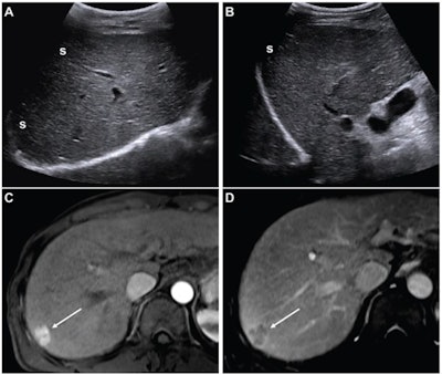 (A,B) Images from an initial ultrasound examination showed no identifiable lesions and received a consensus ultrasound category of US-1. Nearly the entire liver is visualized, with minimal shadowing (“s”, A and B), and the examination received consensus result of VIS-A. The AFP level was 7.1 ng/mL on assessment six months before the ultrasound, 9.1 ng/mL on assessment three months before examination, and 14.2 ng/mL on assessment on exam day. The AFP result was thus assessed as positive based on a progressive increase on two consecutive tests. The atient was considered to have negative surveillance result according to LI-RADS Ultrasound Surveillance v2017, but positive surveillance result according to LI-RADS Ultrasound Surveillance v2024. (C-D) Axial arterial-phase (C) and portal-venous phase (D) T1-weighted images from subsequent gadoxetic acid-enhanced MRI show a 2-cm arterial-phase hyperenhancing observation (arrow, C) with portal-venous washout (arrow, D) in segment 7. This observation was classified on MRI as LR-5, thus meeting the present study’s reference standard for diagnosis of HCC. The mass is located in the periphery of the liver, an anatomic area where ultrasound visualization can be challenging due to shadowing.