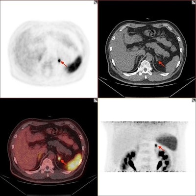 Image of positive adrenal lesion with small size. A 59-year-old male PA patient with one small size lesion in left adrenal gland was identified as positive by Ga-68 pentixafor PET/CT, with a SUVmax of 7.7 and a diameter of 0.8 cm. This patient achieved both complete clinical and biochemical success after laparoscopic total adrenalectomy and result of pathological diagnosis was aldosterone-producing adenoma. Images available for republishing under Creative Commons license (CC BY 4.0 DEED, Attribution 4.0 International) and courtesy of the Journal of Clinical & Translational Endocrinology.