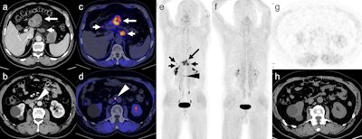 Representative case 1. T4a staging of primary lesions (long arrow) and regional node-positive (short arrow) on contrast-enhanced CT (a). A normal-size (7 mm in short axis) node at the para-aortic region on contrast-enhanced CT (arrowhead, b). The primary tumor and regional nodes, showing a maximum standardized uptake value (SUVmax) of 13.5 and 12.4 respectively, with radiotracer accumulation on PET (c). The para-aortic node, with an SUVmax of 11.6, indicating tracer accumulation on PET (arrowhead, d). The maximum projection image of PET (e). f, g,h show the results of another Ga-68 FAPI- PET/CT scan after six cycles of immunotherapy. The PET maximum projection image (f), axial PET (g), and CT (h) at the level of the para-aortic node, with no identifiable tumor lesions. Images available for republishing under Creative Commons license (CC BY 4.0 DEED, Attribution 4.0 International) and courtesy of the Journal of Cancer Research and Clinical Oncology.