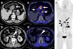Fapi Pet Gastric Cancer Thumbnail