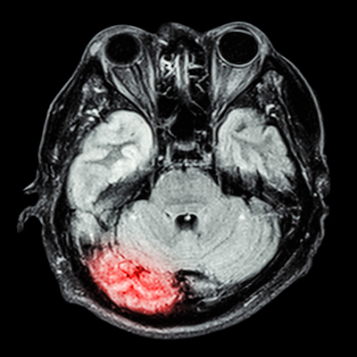 Mri Brain Disease1 400
