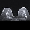 Mri Breast 400