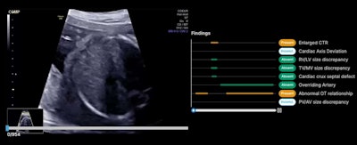 Example of an ultrasound exam being evaluated through an AI system. Researchers found that AI assistance boosted CHD performance among ob/gyns and MFMs reading ultrasound exams.