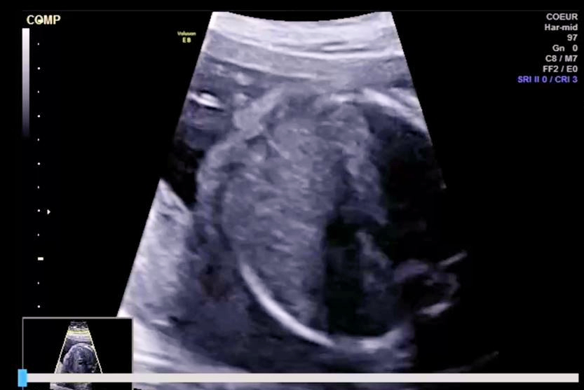 Smfm Ultrasound Ai Fetal Thumbnail