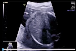 Smfm Ultrasound Ai Fetal Thumbnail