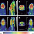Micro-PET/CT images of rats. (a) At 24 hours in the control group, F-18 FDG uptake in rats brain tissue was normal, and the PET/CT images were red and white; (b) At 7 days in the control group, F-18 FDG uptake in rats brain tissue were normal, and the PET/CT images were red and white; (c) At 24 hours after TMT exposure, F-18 FDG uptake in rats brain tissue were in a low state, and the PET/CT images were orange and yellow. (d) 7 days after TMT exposure, F-18 FDG uptake in rats brain tissue further decreased, and the PET/CT images appeared yellow and light yellow. There was no significant difference in the uptake of muscle tissue between the model group and the control group, and the PET/CT image was blue. Image available for republishing under Creative Commons license (CC BY 4.0 DEED, Attribution 4.0 International) and courtesy of Scientific Reports.