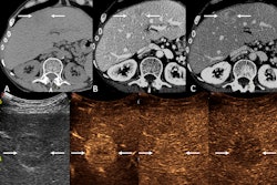 Images depict a 49-year-old female participant with cryptogenic cirrhosis who presented with a 3.2-cm liver lesion. This biopsy-confirmed hepatocellular carcinoma (HCC) with an initial categorization of Liver Imaging Reporting and Data System (LI-RADS) category LR-4 (probably HCC) at CT was upgraded to LR-5 (definitely HCC) at contrast-enhanced ultrasound (CEUS). (A) Precontrast CT images in the liver show vague hypoattenuation in the medial left hepatic lobe (arrows). (B) Arterial phase images demonstrate no definite arterial phase hyperenhancement (arrows). (C) Washout and an enhancing capsule (arrows) on a late-phase image resulted in an LR-4 categorization. (D) B-mode ultrasound shows a round hypoechoic nodule (arrows). (E) An early-phase CEUS image shows clear arterial-phase hyperenhancement (arrows); (F) No washout at one minute (arrows), and (G) late, mild washout at four minutes (arrows) resulted in a CEUS LR-5 categorization.