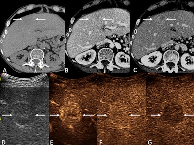 Images depict a 49-year-old female participant with cryptogenic cirrhosis who presented with a 3.2-cm liver lesion. This biopsy-confirmed hepatocellular carcinoma (HCC) with an initial categorization of Liver Imaging Reporting and Data System (LI-RADS) category LR-4 (probably HCC) at CT was upgraded to LR-5 (definitely HCC) at contrast-enhanced ultrasound (CEUS). (A) Precontrast CT images in the liver show vague hypoattenuation in the medial left hepatic lobe (arrows). (B) Arterial phase images demonstrate no definite arterial phase hyperenhancement (arrows). (C) Washout and an enhancing capsule (arrows) on a late-phase image resulted in an LR-4 categorization. (D) B-mode ultrasound shows a round hypoechoic nodule (arrows). (E) An early-phase CEUS image shows clear arterial-phase hyperenhancement (arrows); (F) No washout at one minute (arrows), and (G) late, mild washout at four minutes (arrows) resulted in a CEUS LR-5 categorization.