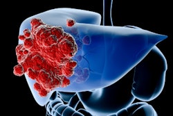 Liver Cancer Thumbnail
