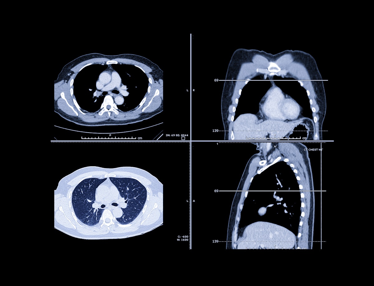 Machine Learning Predicts Immunotherapy Response in NSCLC Patients: Study Insights