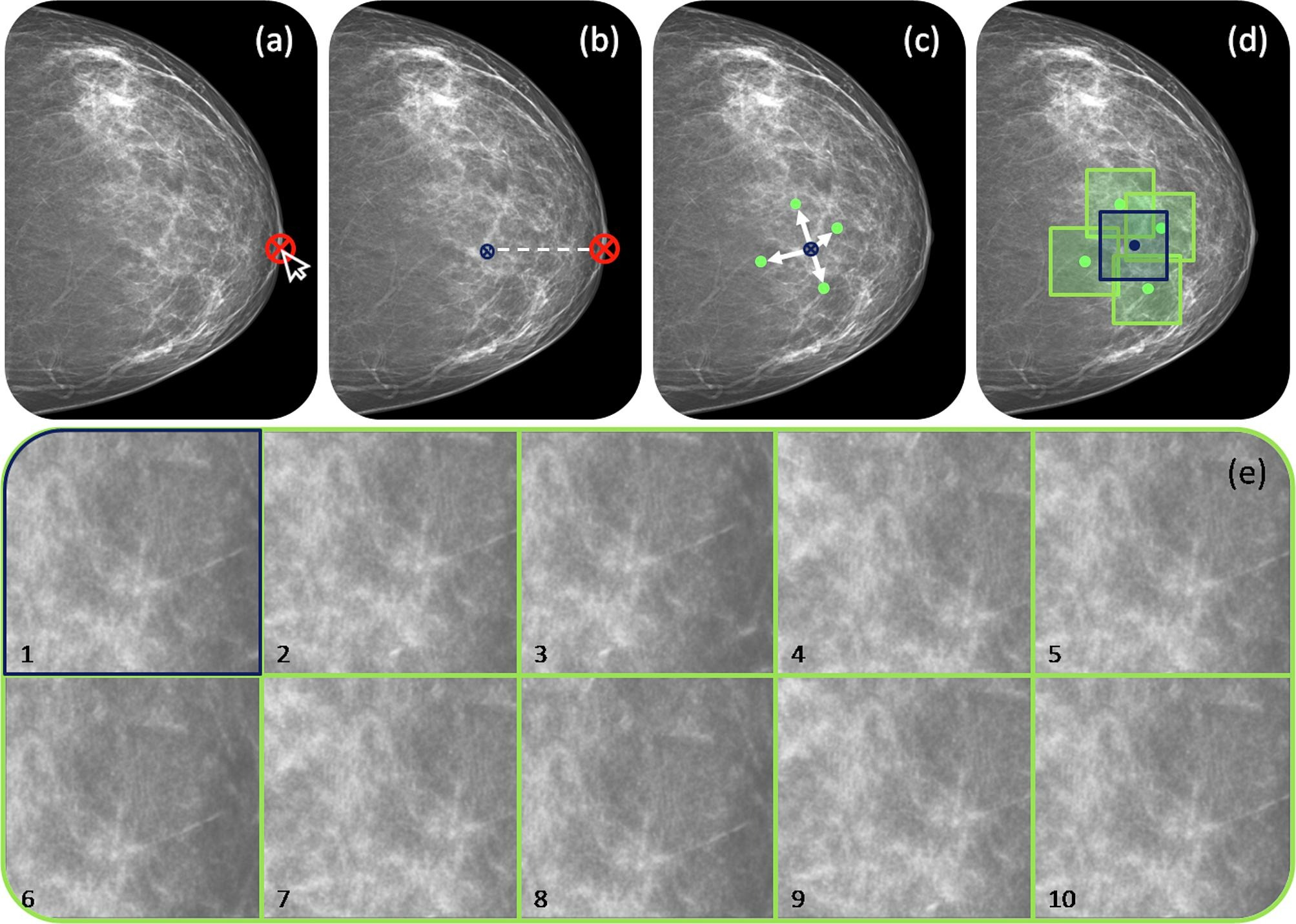 Delineation workflow: The various steps of the contouring process: (a) the nipple is manually annotated (b) a reference point is placed 30 mm behind the nipple (c) 10 random theta/displacement values are selected to obtain the central point of each ROI (d) Regions of interest are placed on the image. (e) The resulting 10 ROIs obtained for a representative subject (viewing window [0 10000]). Images are published under a Creative Commons license (CC BY-NC-ND 4.0).