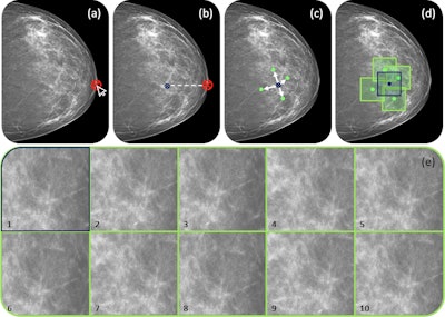 Delineation workflow: The various steps of the contouring process: (a) the nipple is manually annotated (b) a reference point is placed 30 mm behind the nipple (c) 10 random theta/displacement values are selected to obtain the central point of each ROI (d) Regions of interest are placed on the image. (e) The resulting 10 ROIs obtained for a representative subject (viewing window [0 10000]). Images are published under a Creative Commons license (CC BY-NC-ND 4.0).