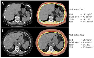 Body composition analysis of axial CT images at the level of the 12th thoracic vertebral body for two female patients ages (A) 74 and (B) 82 who underwent lobectomy for stage IIB non-small cell lung cancer, both with a body mass index (BMI, calculated as weight in kilograms divided by height in meters squared) of 26.7. The former patient (A) died 2 years after surgery, and the latter patient (B) was censored after 5.2 years. The segmentation results on the right show skeletal muscle (beige), subcutaneous adipose tissue (brown), and intermuscular adipose tissue (IMAT, blue). The anatomic fascia separating the body composition compartments are depicted in red (membranous layer of the superficial fascia) and yellow (fascia transversalis and endothoracic fascia of the fascia trunci interna). Images and caption courtesy of the RSNA.