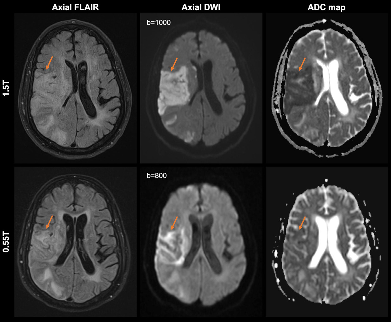 Are low-field MRI units effective for neuroradiologic imaging? | AuntMinnie