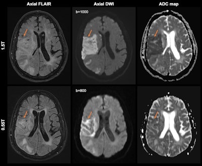 Acute right middle cerebral artery territory infarction (arrows) in a 66-year-old man, imaged at 1.5-tesla first and then at 0.55-tesla nine days later. Initial 1.5-tesla MRI images (top row) show diffusion restriction with associated mild T2 prolongation, compatible with acute infarction. On the subsequent 0.55-tesla images (bottom row), there is expected evolution of the infarct, with normalization of the apparent diffusion coefficient (ADC) map. Acquisition times for FLAIR imaging were 2 minutes, 45 seconds (with deep learning reconstruction) for 1.5-tesla imaging and 4 minutes, 14 seconds for 0.55-tesla imaging. The acquisition times for DWI were 1 minute, 3 seconds for 1.5-tesla imaging and 2 minutes, 52 seconds for 0.55-tesla imaging. Images and caption courtesy of the RSNA.