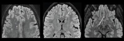 Axial FLAIR images of brain from baseline 3-T MRI examinations in 3 different participants with acute mTBI, showing abnormal WMHs based on varying criteria. (A) 41-year-old participant. Image shows five punctate hyperintense foci in frontal lobes (arrowheads), including four foci on the and one focus on left. (B) 16-year-old participant. Image shows 1-cm patchy hyperintense focus (arrow) in left frontal periventricular white matter. (C) 47-year-old participant. Image shows hyperintense focus in atypical location along right optic radiation (arrow). Images and caption courtesy of the ARRS.