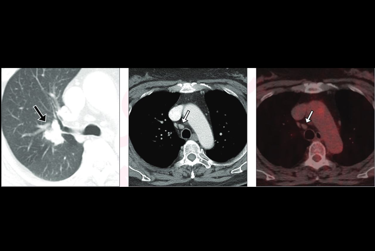 2025 02 19 Ajr Lung Images Thumbnail