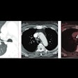 2025 02 19 Ajr Lung Images Thumbnail
