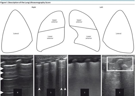 1Each lung has been split into three parts. Each area has been given a score between 0 and 3. Score values are shown in Ultrasonograms to match 4 different patterns. During a longitudinal scan with a high-resolution linear probe, pictures of patterns were taken. The scores are as follows: 0 means A pattern, 1 means B pattern, 2 means severe B pattern, and 3 means extended consolidation. Images available for publishing under a creative commons license, CC BY-NC-ND 4.0.