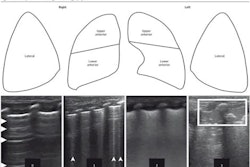 1Each lung has been split into three parts. Each area has been given a score between 0 and 3. Score values are shown in Ultrasonograms to match 4 different patterns. During a longitudinal scan with a high-resolution linear probe, pictures of patterns were taken. The scores are as follows: 0 means A pattern, 1 means B pattern, 2 means severe B pattern, and 3 means extended consolidation. Images available for publishing under a creative commons license, CC BY-NC-ND 4.0.