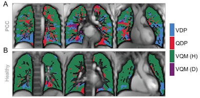Images show exemplary coronal sections of phase-resolved functional lung MRI defect maps in a pediatric participant with post-COVID-19 condition (PCC) and cardiopulmonary symptoms and a healthy control patient. (A) Images in a 17-year-old male participant with PCC show a ventilation defect percentage (VDP) of 17%, a perfusion defect percentage (QDP) of 16%, a ventilation/perfusion (V/Q) match healthy (VQM [H]) percentage of 64%, and a V/Q mismatch defect (VQM [D]) of 3%. (B) Images in a healthy control participant, with a ventilation defect percentage of 9%, a perfusion defect percentage of 5%, a V/Q match healthy percentage of 86%, and no V/Q mismatch defect. Images and caption courtesy of the RSNA.