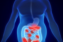 3 D Illustration Crohn Disease