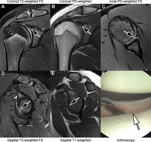 Images in an 18-year-old man with recurrent dislocations of the right shoulder. (A, B) Unenhanced coronal, (C) axial, and (D, E) sagittal deep learning super-resolution threefold parallel imaging -- accelerated turbo spin-echo MRI scans were obtained at 3-tesla field strength. (A) Coronal T2-weighted fat-suppressed (FS) and (B) coronal proton density (PD)-weighted MRI scans show a nondisplaced superior labral tear (arrows). (C) Axial proton density-weighted fat-suppressed, (D) sagittal T2-weighted fat-suppressed, and (E) sagittal T1-weighted MRI scans show continuation into a nondisplaced anteroinferior labral tear (arrows). All seven readers correctly diagnosed the arthroscopy-validated findings. (F) An arthroscopic photograph shows the anteroinferior labral tear (arrow). Image and caption courtesy of the RSNA.