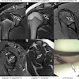 Images in an 18-year-old man with recurrent dislocations of the right shoulder. (A, B) Unenhanced coronal, (C) axial, and (D, E) sagittal deep learning super-resolution threefold parallel imaging -- accelerated turbo spin-echo MRI scans were obtained at 3-tesla field strength. (A) Coronal T2-weighted fat-suppressed (FS) and (B) coronal proton density (PD)-weighted MRI scans show a nondisplaced superior labral tear (arrows). (C) Axial proton density-weighted fat-suppressed, (D) sagittal T2-weighted fat-suppressed, and (E) sagittal T1-weighted MRI scans show continuation into a nondisplaced anteroinferior labral tear (arrows). All seven readers correctly diagnosed the arthroscopy-validated findings. (F) An arthroscopic photograph shows the anteroinferior labral tear (arrow). Image and caption courtesy of the RSNA.