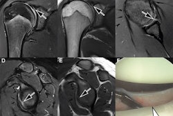 Images in an 18-year-old man with recurrent dislocations of the right shoulder. (A, B) Unenhanced coronal, (C) axial, and (D, E) sagittal deep learning super-resolution threefold parallel imaging -- accelerated turbo spin-echo MRI scans were obtained at 3-tesla field strength. (A) Coronal T2-weighted fat-suppressed (FS) and (B) coronal proton density (PD)-weighted MRI scans show a nondisplaced superior labral tear (arrows). (C) Axial proton density-weighted fat-suppressed, (D) sagittal T2-weighted fat-suppressed, and (E) sagittal T1-weighted MRI scans show continuation into a nondisplaced anteroinferior labral tear (arrows). All seven readers correctly diagnosed the arthroscopy-validated findings. (F) An arthroscopic photograph shows the anteroinferior labral tear (arrow). Image and caption courtesy of the RSNA.