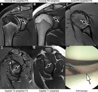 Images in an 18-year-old man with recurrent dislocations of the right shoulder. (A, B) Unenhanced coronal, (C) axial, and (D, E) sagittal deep learning super-resolution threefold parallel imaging -- accelerated turbo spin-echo MRI scans were obtained at 3-tesla field strength. (A) Coronal T2-weighted fat-suppressed (FS) and (B) coronal proton density (PD)-weighted MRI scans show a nondisplaced superior labral tear (arrows). (C) Axial proton density-weighted fat-suppressed, (D) sagittal T2-weighted fat-suppressed, and (E) sagittal T1-weighted MRI scans show continuation into a nondisplaced anteroinferior labral tear (arrows). All seven readers correctly diagnosed the arthroscopy-validated findings. (F) An arthroscopic photograph shows the anteroinferior labral tear (arrow). Image and caption courtesy of the RSNA.