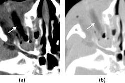 A 7-year-old boy, imaged 15 hours post-injury. Axial CT images with soft tissue windows (WW/WL=350/50) (a) reveal a rod-shaped foreign body (white arrow) situated along the course of the right inferior rectus muscle. The soft tissue window demonstrates that the foreign body exhibits attenuation similar to orbital emphysema. Axial CT images (WW/WL=1000/−200) at the same level (b) show that the attenuation of the foreign body (white arrow) is markedly different from that of the air in the sinuses. Image and caption courtesy of Dapeng Hao, MD, also of the Affiliated Hospital of Qingdao University.