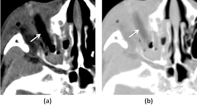 A 7-year-old boy, imaged 15 hours post-injury. Axial CT images with soft tissue windows (WW/WL=350/50) (a) reveal a rod-shaped foreign body (white arrow) situated along the course of the right inferior rectus muscle. The soft tissue window demonstrates that the foreign body exhibits attenuation similar to orbital emphysema. Axial CT images (WW/WL=1000/−200) at the same level (b) show that the attenuation of the foreign body (white arrow) is markedly different from that of the air in the sinuses. Image and caption courtesy of Dapeng Hao, MD, also of the Affiliated Hospital of Qingdao University.