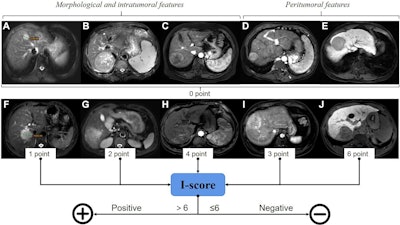 Assignment of the Image score (I-score) based on imaging features assessed on axial gadoxetic acid-enhanced MRI scans. (A–E) Imaging features representing zero points: (A) maximum tumor diameter (TD-max) of 4.0 cm or less, (B) regular shape, (C) no intratumoral arteries (ITAs), (D) no peritumoral enhancement in the arterial phase, and (E) absence of low peritumoral signal intensity in the hepatobiliary phase. (F–J) Imaging features representing added points: (F) one point for TD-max greater than 4 cm, (G) two points for irregular morphology, (H) four points for ITAs, (I) three points for peritumoral enhancement in the arterial phase, and (J) six points for low peritumoral signal intensity in the hepatobiliary phase. The features were assessed, and a scoring model with continuous I-score was established to evaluate high-risk pathologic features in hepatocellular carcinoma. The threshold value of the I-score obtained via receiver operating characteristic curve analysis was used to predict high-risk pathologic features. When the I-score was greater than 6, it was considered positive; otherwise, it was considered negative. TD-max and morphology can also be assessed on T2-weighted images. Image and caption courtesy of RSNA.