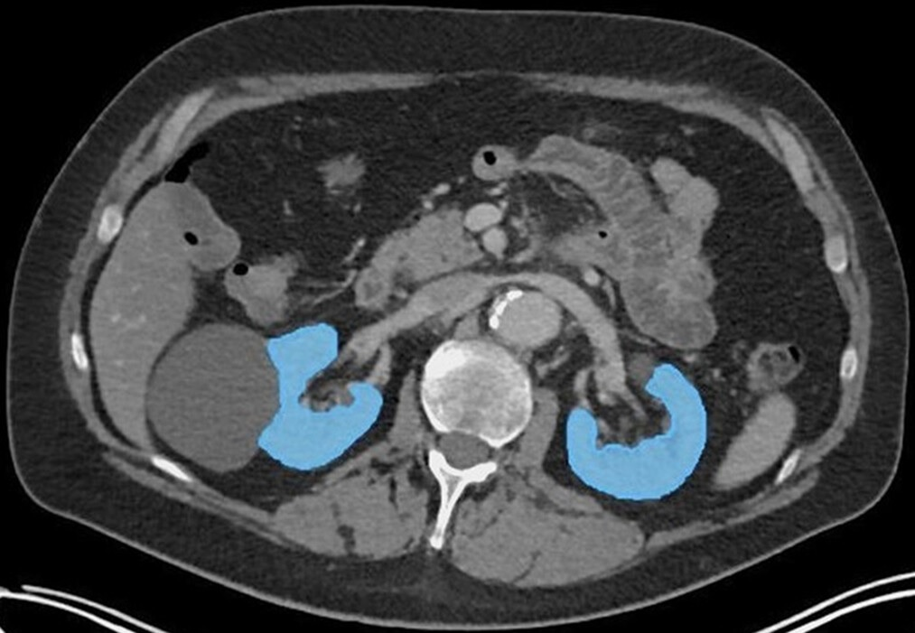 An axial CT image illustrating segmentation of functioning kidney tissue (blue areas), excluding kidney cysts and renal pelvis, using TotalSegmentator. Image and caption courtesy of RSNA.