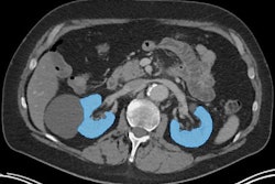 An axial CT image illustrating segmentation of functioning kidney tissue (blue areas), excluding kidney cysts and renal pelvis, using TotalSegmentator. Image and caption courtesy of RSNA.