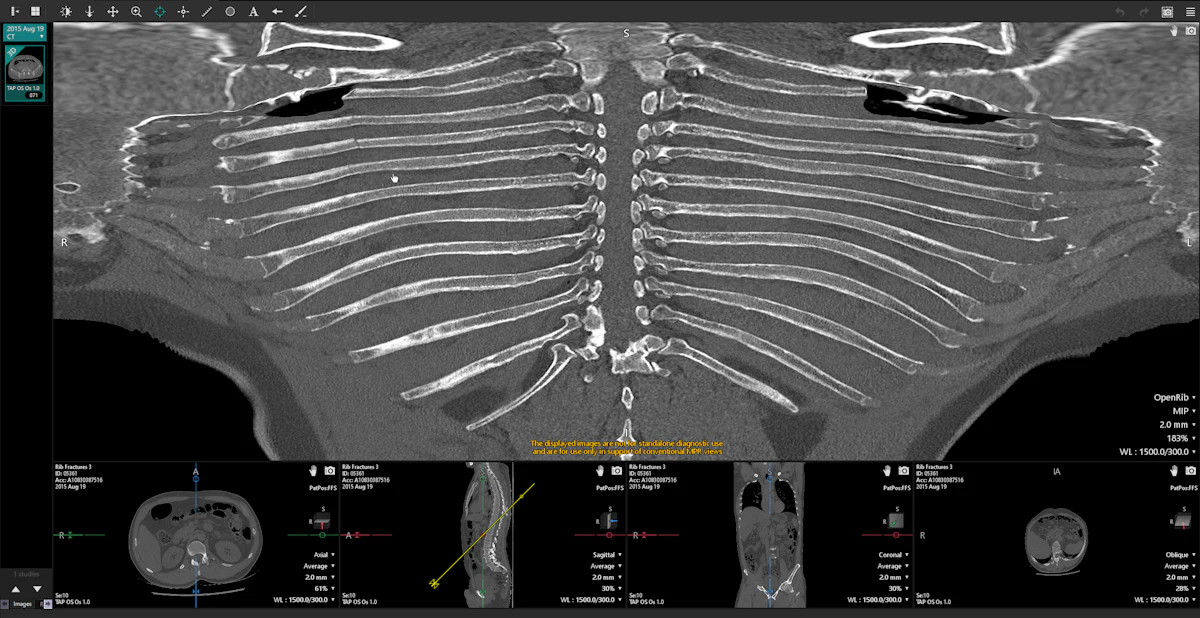 Radiologists target rib fracture detection in trauma patients | AuntMinnie