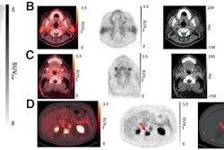 (A) Representative maximum-intensity projection and selected PET/CT images (fused, PET and CT only) of patient with metastatic prostate cancer at 1 hour after injection. (B and C) Low uptake of Ga-68 PSMA-R2 in salivary and submandibular glands is also demonstrated. (D) Images show heterogeneous uptake of Ga-68 PSMA-R2 with varying degrees of intensity in multiple spine bone lesions (vertebral sclerotic lesion with intense PSMA-R2 expression at its periphery indicated with red arrow). HU = Houndsfield unit; SUVbw = body-weight SUV. Images and caption courtesy of the Journal of Nuclear Medicine.