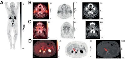 (A) Representative maximum-intensity projection and selected PET/CT images (fused, PET and CT only) of patient with metastatic prostate cancer at 1 hour after injection. (B and C) Low uptake of Ga-68 PSMA-R2 in salivary and submandibular glands is also demonstrated. (D) Images show heterogeneous uptake of Ga-68 PSMA-R2 with varying degrees of intensity in multiple spine bone lesions (vertebral sclerotic lesion with intense PSMA-R2 expression at its periphery indicated with red arrow). HU = Houndsfield unit; SUVbw = body-weight SUV. Images and caption courtesy of the Journal of Nuclear Medicine.