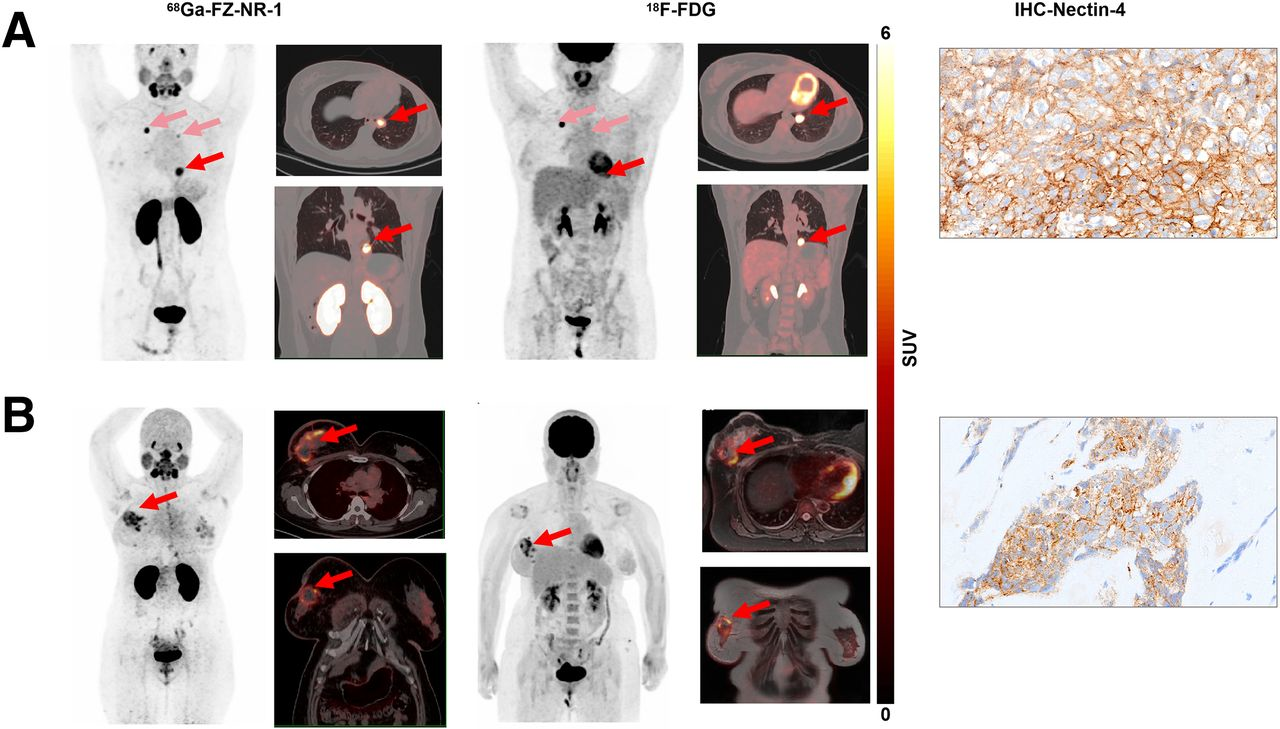 Ga-68 FZ-NR-1 PET/CT images and F-18 FDG PET/CT and PET/MRI images in representative nectin-4-positive TNBC patients. (A) PET/CT images and nectin-4 immunohistochemistry (IHC) staining of patient 1. Maximum-intensity projection (MIP) images and axial and coronal PET/CT images of Ga-68 FZ-NR-1 and F-18 FDG both showed high uptake in lung metastases (arrow). (B) PET/CT images and nectin-4 IHC staining of patient 2. MIP images and axial and coronal PET/CT images of Ga-68 FZ-NR-1 showed high uptake in recurrence of right breast cancer after surgery (arrow), and those of F-18 FDG PET/MRI showed high uptake. Image courtesy of the Journal of Nuclear Medicine.