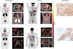 Ga-68 FZ-NR-1 PET/CT images and F-18 FDG PET/CT and PET/MRI images in representative nectin-4-positive TNBC patients. (A) PET/CT images and nectin-4 immunohistochemistry (IHC) staining of patient 1. Maximum-intensity projection (MIP) images and axial and coronal PET/CT images of Ga-68 FZ-NR-1 and F-18 FDG both showed high uptake in lung metastases (arrow). (B) PET/CT images and nectin-4 IHC staining of patient 2. MIP images and axial and coronal PET/CT images of Ga-68 FZ-NR-1 showed high uptake in recurrence of right breast cancer after surgery (arrow), and those of F-18 FDG PET/MRI showed high uptake. Image courtesy of the Journal of Nuclear Medicine.