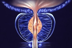 Benign Prostatic Hyperplasia