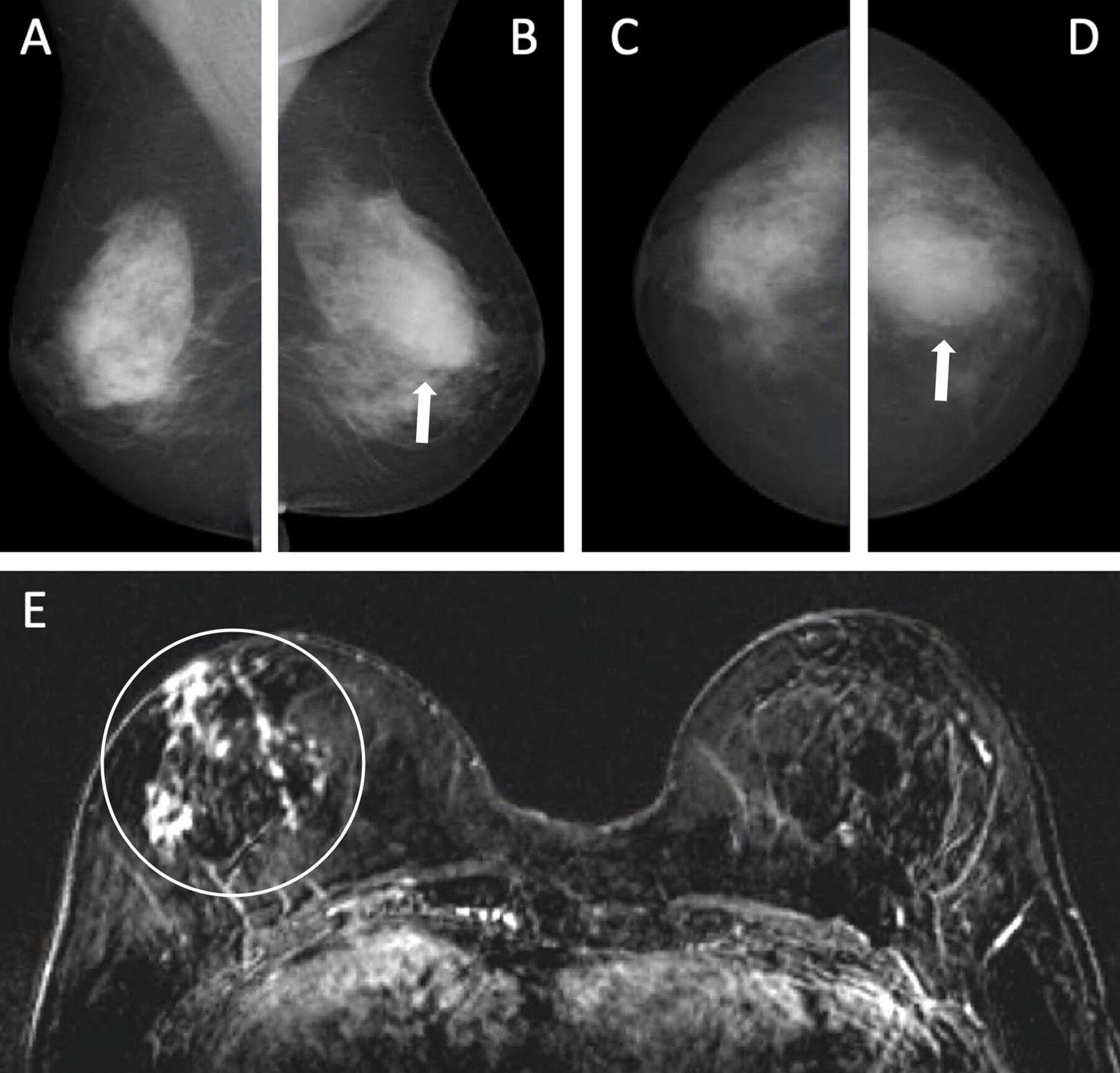 Images depict a 55-year-old woman with a family history of breast cancer who underwent combined mammography and MRI screening. (A) Right and (B) left mediolateral oblique and (C) right and (D) left craniocaudal mammograms show a large known cyst in the left breast (arrow in B and D), but were otherwise assessed as being unremarkable. Breast tissue was judged to be extremely dense. (E) Concurrent axial subtraction MRI scan shows a large, diffuse, invasive lobular cancer (circle) in the right breast. The AI system provided a case-based cancer suspicion score of 8 on a scale of 0-10, which would have led to selection for MRI screening using both the score 5 and score 8 thresholds, but not the score 9 threshold.