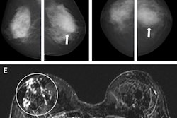 Images depict a 55-year-old woman with a family history of breast cancer who underwent combined mammography and MRI screening. (A) Right and (B) left mediolateral oblique and (C) right and (D) left craniocaudal mammograms show a large known cyst in the left breast (arrow in B and D), but were otherwise assessed as being unremarkable. Breast tissue was judged to be extremely dense. (E) Concurrent axial subtraction MRI scan shows a large, diffuse, invasive lobular cancer (circle) in the right breast. The AI system provided a case-based cancer suspicion score of 8 on a scale of 0-10, which would have led to selection for MRI screening using both the score 5 and score 8 thresholds, but not the score 9 threshold.