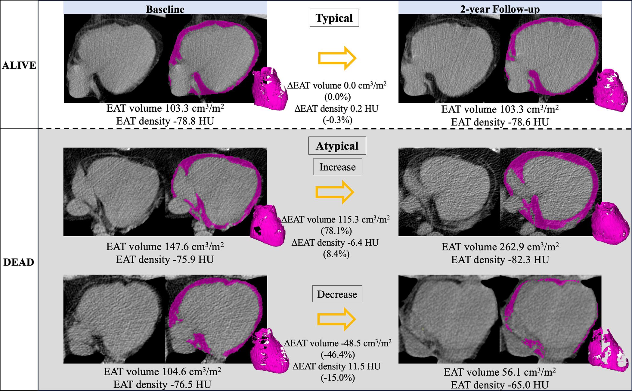 Epicardial adipose tissue (EAT) segmentation (shading) at noncontrast chest CT in axial orientation. Representative examples show EAT changes (&Delta;EAT) between baseline and two-year follow-up CT scans in participants who survived (typical changes) and increasing and decreasing EAT in participants who died. Images and caption courtesy of the RSNA.