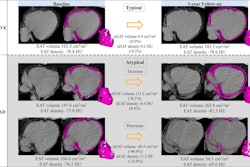Epicardial adipose tissue (EAT) segmentation (shading) at noncontrast chest CT in axial orientation. Representative examples show EAT changes (ΔEAT) between baseline and two-year follow-up CT scans in participants who survived (typical changes) and increasing and decreasing EAT in participants who died. Images and caption courtesy of the RSNA.